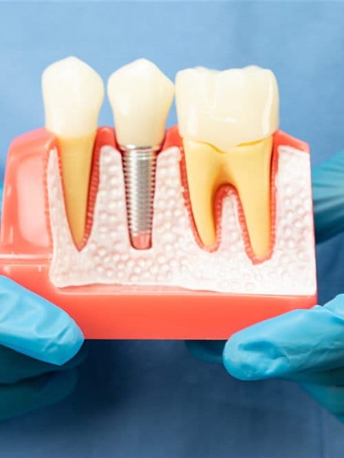 Implantes dentales en A Coruña - Encisa
